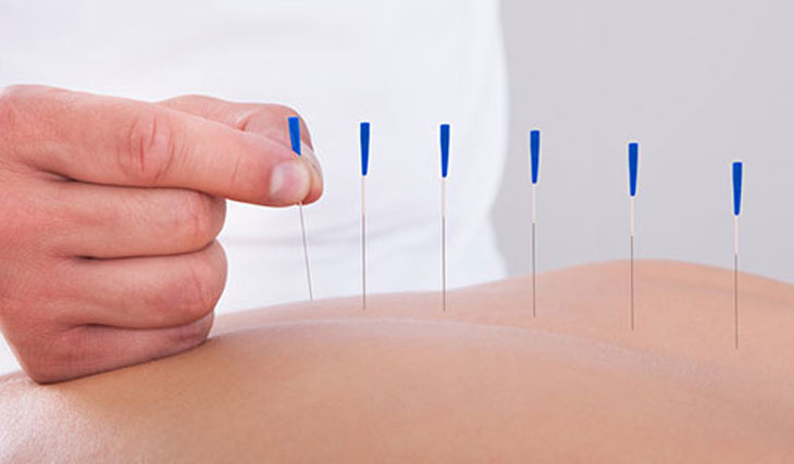 Dry needling treatment